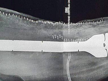 Operacja total femur Operacja total femur